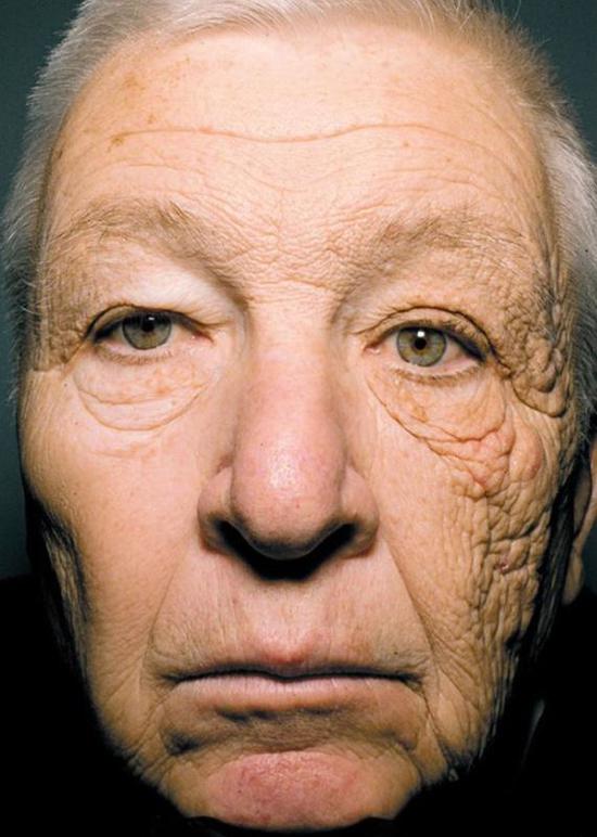 ▲根据《新英格兰医学杂志》报道，69岁的Bill McElligott 从事送货工作已经有28年了。紫外线透过车窗直接照射在他的左脸上，严重损坏了该侧的皮肤，导致他左脸比右脸衰老更明显。
