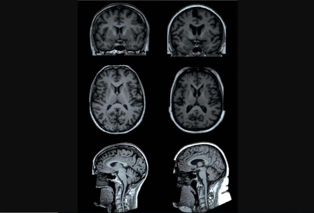 一项最新研究发现，体脂越高，大脑某些区域容量就越小。上图为研究中两名测试者(年龄均为65岁的女性)的大脑核磁共振扫描。一名测试者(左侧图)体脂为13%，另一名测试者(右侧图)体脂为49%。核磁共振扫描显示，与左图测试者相比，右图测试者大脑某些区域(“皮质下区域”)灰质容量较低。