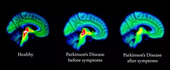  ▲随着帕金森病的发展，脑成像显示，患者的5-羟色胺功能逐渐减退（图片来源：NEURODEGENERATION IMAGING GROUP， KING‘S COLLEGE LONDON）